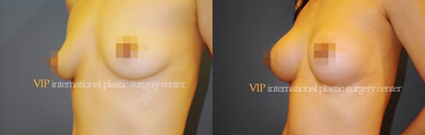 Breast Surgery - Breast surgery