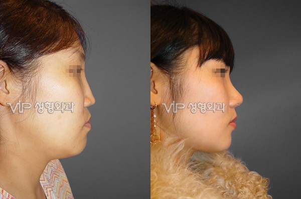 	Harmony-Rhinoplasty, Protruded Mouth Correction Rhinoplasty, Rib cartilage Rhinoplasty	 - VIP Harmony rhinoplasty