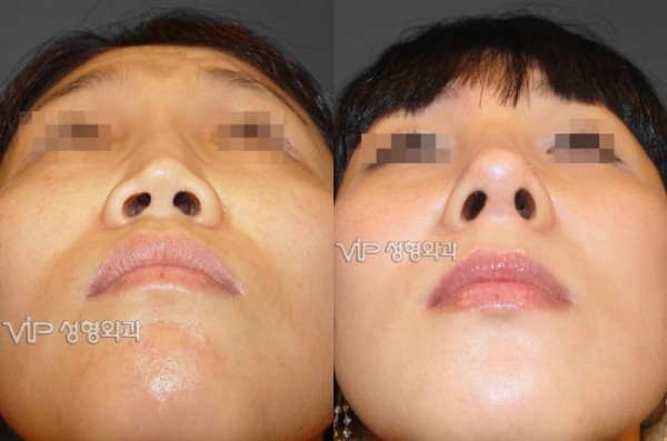 	Harmony-Rhinoplasty, Protruded Mouth Correction Rhinoplasty, Rib cartilage Rhinoplasty	 - VIP Harmony rhinoplasty