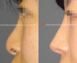 Nostril correction