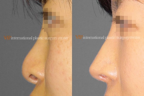 Nose Surgery - Nostril correction