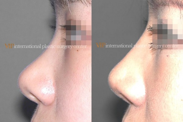 	Nose Surgery	 - Bulbous nose
