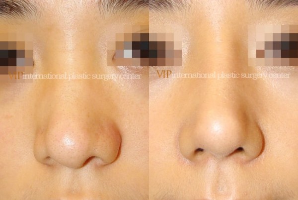 	Nose Surgery	 - Wide nasal bone reduction rhinoplasty