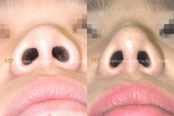 	Nose Surgery	 - Bulbous nose