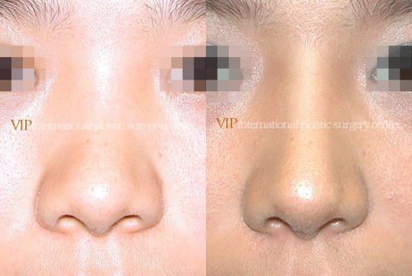 	Nose Surgery	 - Bulbous nose