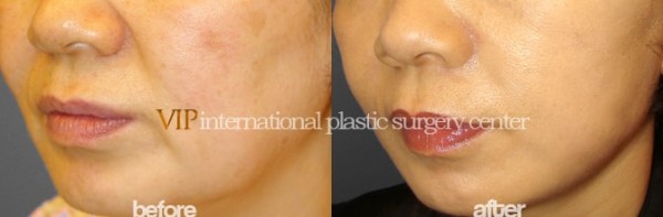 	Face Lift	 - Wrinkle surgery