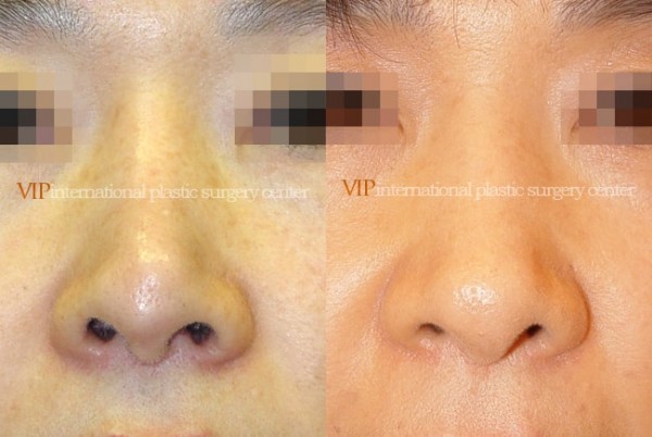 Nose Surgery - Revision rhinoplasty - Tip correction