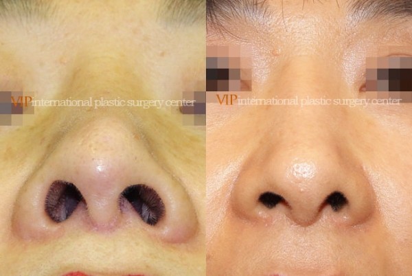 Nose Surgery - Revision rhinoplasty - Tip correction
