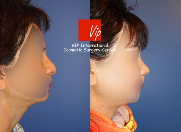 	Nose Surgery, Rib cartilage Rhinoplasty, Each Cases Nose	 - Nasal Columella reduction