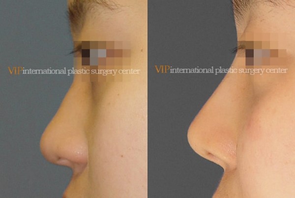 	Nose Surgery	 - Septal cartilage rhinoplasty