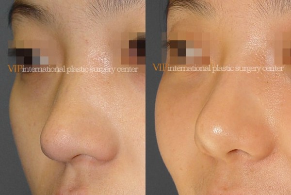 	Nose Surgery	 - Septal cartilage rhinoplasty