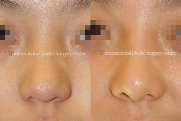 	Nose Surgery	 - Septal cartilage rhinoplasty