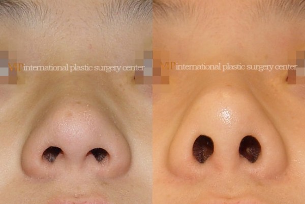 	Nose Surgery	 - Septal cartilage rhinoplasty