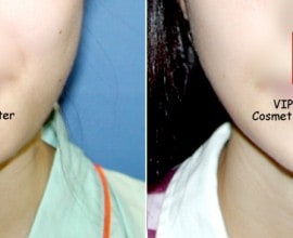 V-line jaw reduction ( T-Square surgery )