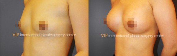 Breast Surgery - Breast surgery