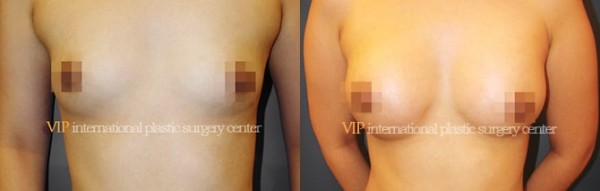 Breast Surgery - Breast surgery