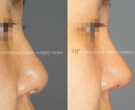 Wide nasal bone reduction rhinoplasty