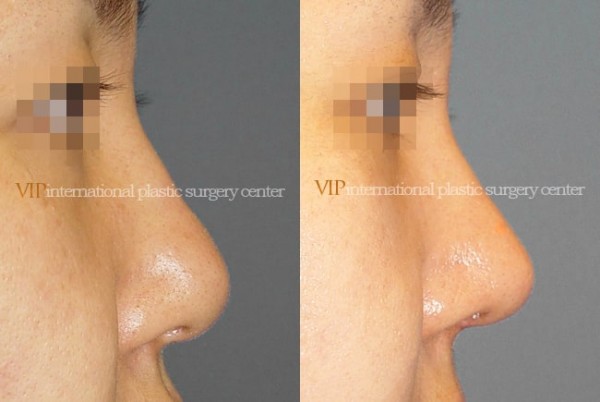 	Nose Surgery	 - Wide nasal bone reduction rhinoplasty