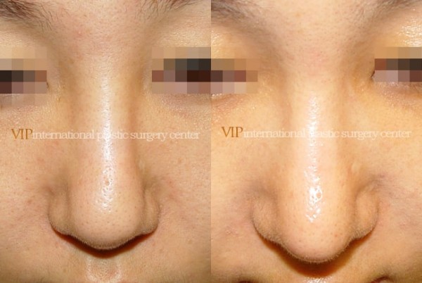 	Nose Surgery	 - Wide nasal bone reduction rhinoplasty