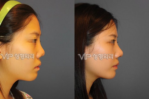 Nose Surgery - Revision rhinoplasty with Septal cartilage