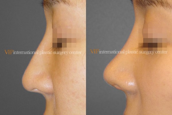 Nose Surgery - Septal cartilage rhinoplasty