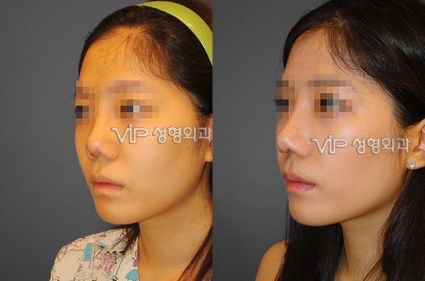 Nose Surgery - Revision rhinoplasty with Septal cartilage