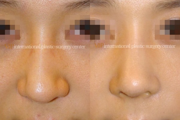 Nose Surgery - Septal cartilage rhinoplasty
