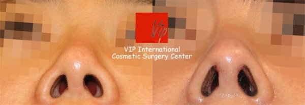 	Rib cartilage Rhinoplasty, Contracted Nose, Revision Rhinoplasty	 - Harmony rhinoplasty - Septal deviation correction+balanced profile view