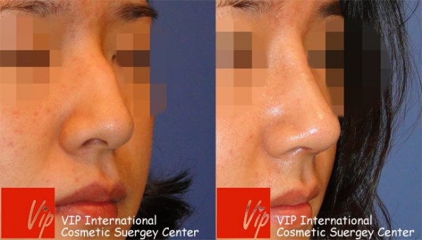 	Nose Surgery, Rib cartilage Rhinoplasty, Each Cases Nose	 - Humped nose correction rhinoplasty