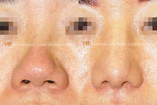 Nose Surgery - Alar base reduction