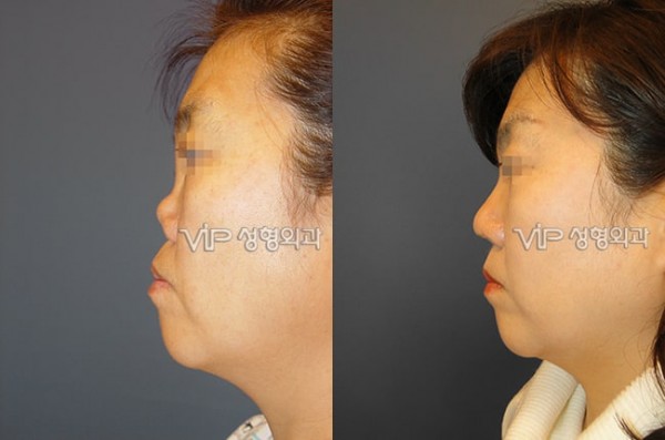 Nose Surgery - Revision rhinoplasty with Rib cartilage - Severe collapsion and contruction due to silicone implant