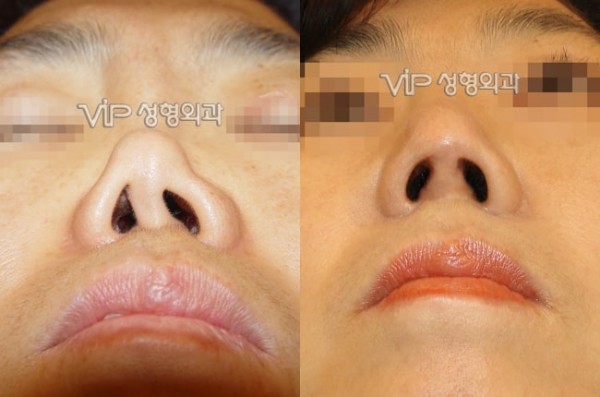 Nose Surgery - Revision rhinoplasty with Rib cartilage - Severe collapsion and contruction due to silicone implant
