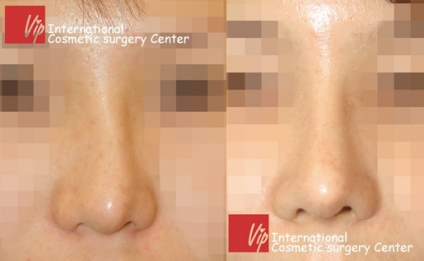 	Nose Surgery, Rib cartilage Rhinoplasty, Revision Rhinoplasty	 - Deviated nose correction