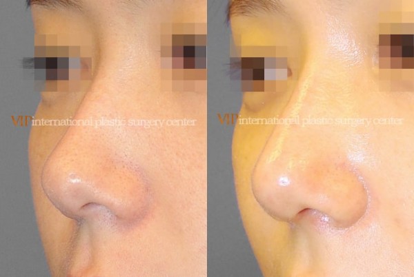 Nose Surgery - Rhinoplasty