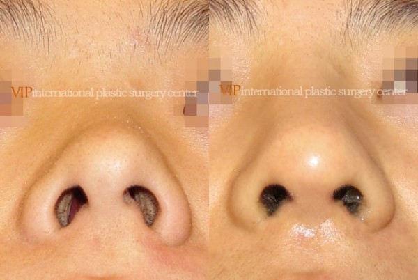 Nose Surgery - Septal deviation correction