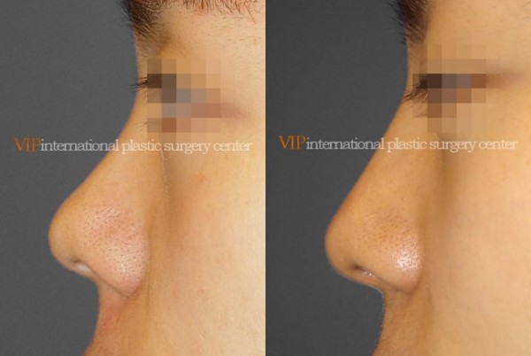 Nose Surgery - Septal deviation correction