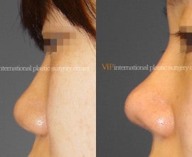 Septal cartilage rhinoplasty