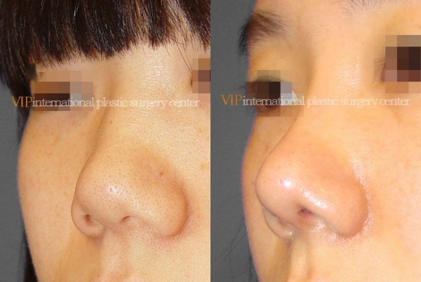 Nose Surgery - Septal cartilage rhinoplasty