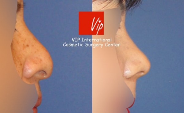 	Nose Surgery, Rib cartilage Rhinoplasty, Each Cases Nose	 - Nasal Columella reduction