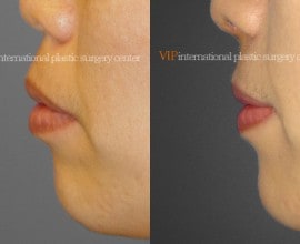 Protruded mouth correction