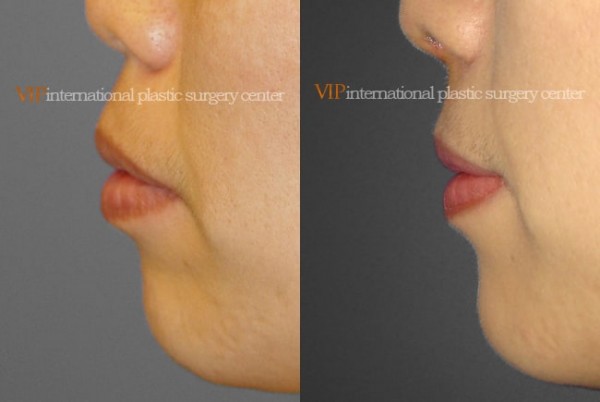	Nose Surgery, Protruded Mouth Correction Rhinoplasty	 - Protruded mouth correction