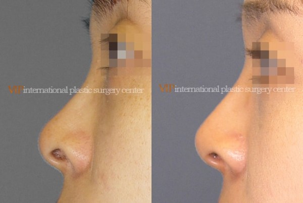 Nose Surgery - Nostril correction