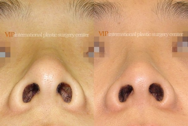 Nose Surgery - Nostril correction