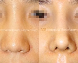 Wide nasal bone reduction rhinoplasty