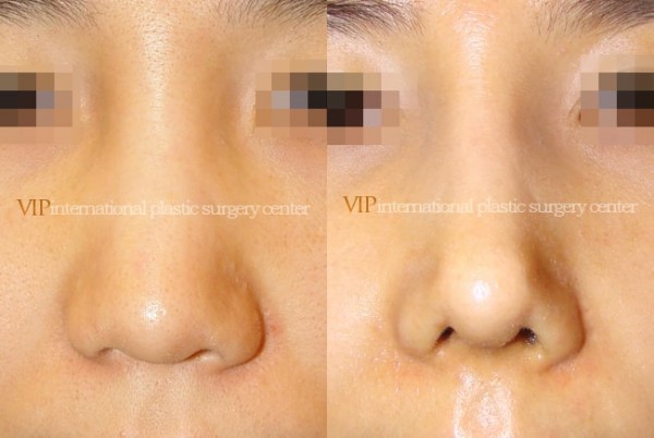 	Nose Surgery	 - Wide nasal bone reduction rhinoplasty