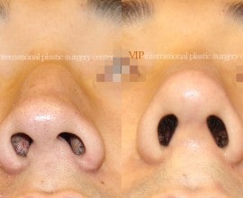 Septal deviation & Humped nose correction