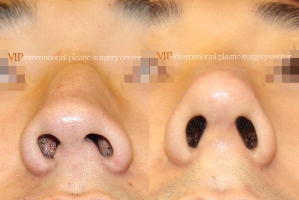 Nose Surgery - Septal deviation & Humped nose correction