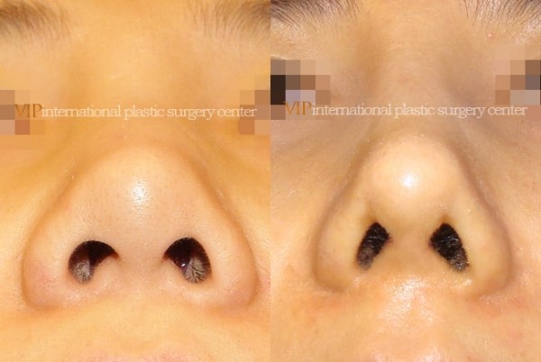 	Nose Surgery	 - Wide nasal bone reduction rhinoplasty