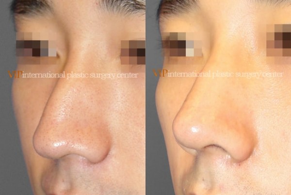 Nose Surgery - Septal deviation & Humped nose correction