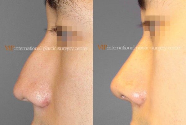 Nose Surgery - Septal deviation & Humped nose correction